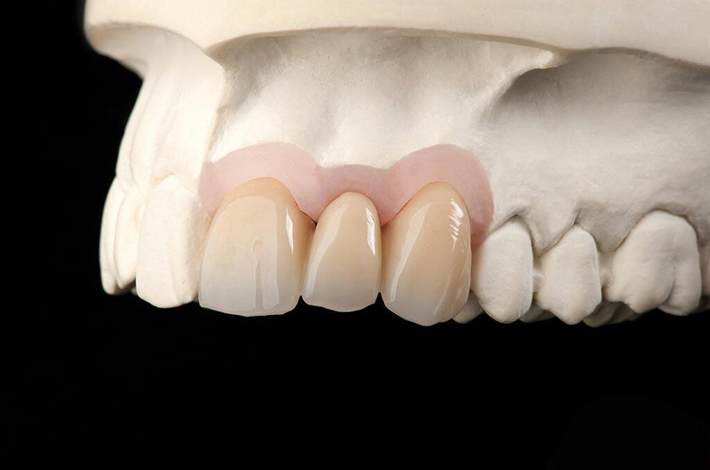 Σταθερές προσθετικές εργασίες